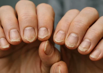Unhas fracas: como tratar e mantê-las fortes e saudáveis com hábitos simples
