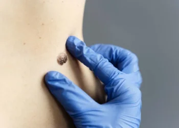 Essa verruga é um sinal de alerta URGENTE da sua saúde!