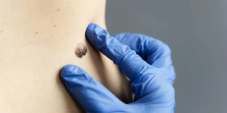 Essa verruga é um sinal de alerta URGENTE da sua saúde!