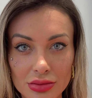 Cirurgia para mudar a cor dos olhos: entenda o procedimento realizado por Andressa Urach