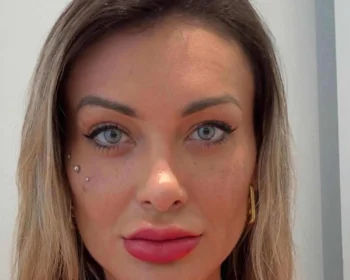 Cirurgia para mudar a cor dos olhos: entenda o procedimento realizado por Andressa Urach