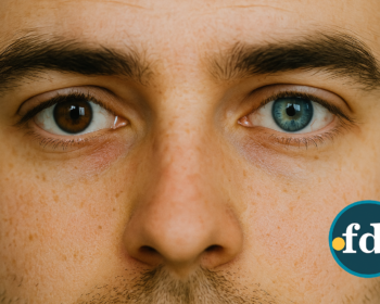 Cirurgia para mudar a cor dos olhos: Como funciona, riscos e custos envolvidos