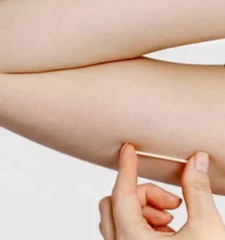 SUS anuncia disponibilização de moderno implante contraceptivo para as mulheres; descubra qual é
