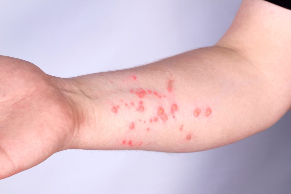 Brasil registra 47 casos do vírus Mpox e Ministério da Saúde faz pronunciamento importante